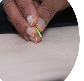 Acupuncture