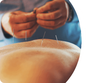 Acupuncture
