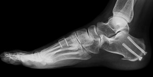 Cavus Foot Reconstruction