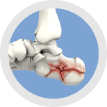 Img-Foot & Ankle Fractures