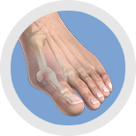 Img-Minimally Invasive Bunion Correction