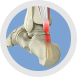 Img-Minimally Invasive Achilles Tendon Rupture Repair