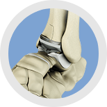 Img-Total Ankle Replacement