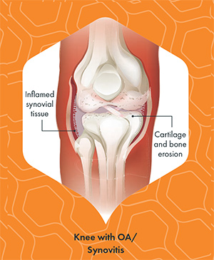 Knee with OA/Sunovitis