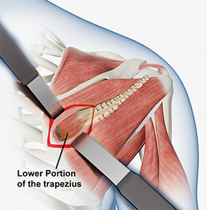 Lower Trapezius Tendon Transfer