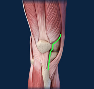 Subvastus Knee Approach