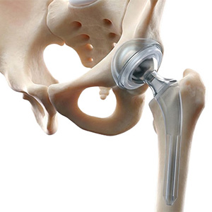 Total Hip Replacement pic