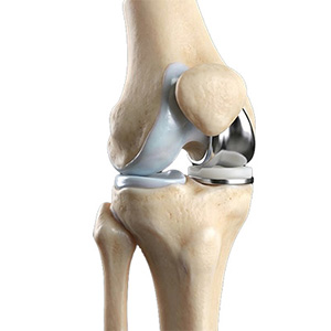 Unicompartmental/Partial Knee Replacement pic