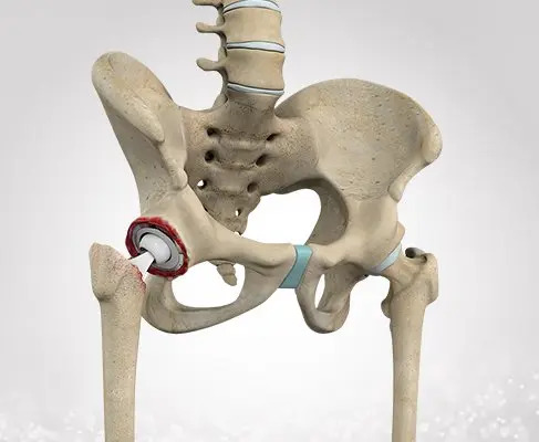 Revision Total Joint Replacement