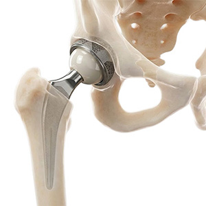 Robotic-Assisted Hip Replacement Device-pic2