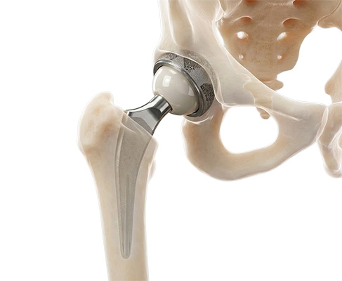 Robotic Hip Replacement