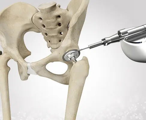 Robotic Hip Replacement