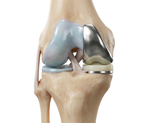 Robotic Partial Knee Replacement