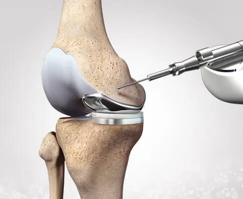 Robotic Partial Knee Replacement