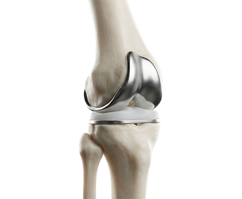 Robotic Total Knee Replacement