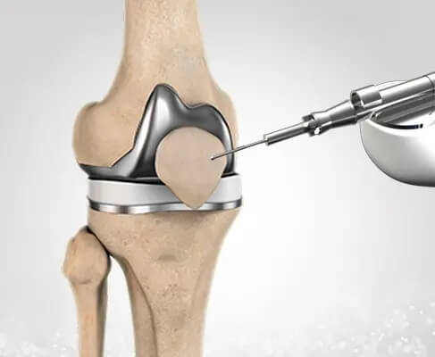 Robotic Total Knee Replacement