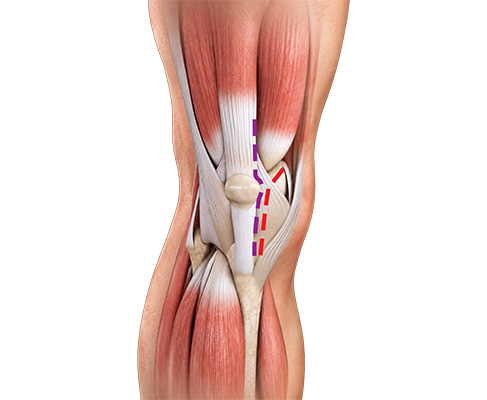 Subvastus Total Knee Replacement