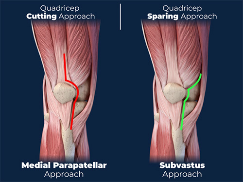 Subvastus Knee Approach pic