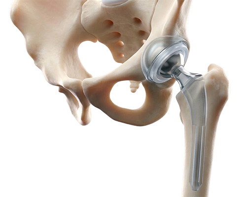 Total Hip Replacement