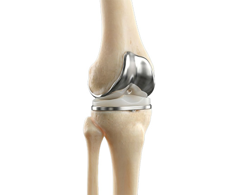 Total Knee Replacement