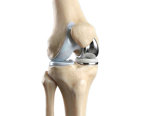 Partial Knee Replacement