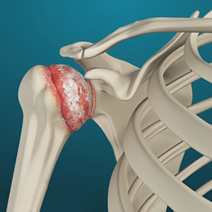 Picture of Arthritis of the Shoulder 