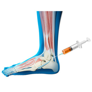 Picture of Bone Marrow Aspirate Concentrate (BMAC) Treatment