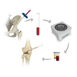 Picture of Bone Marrow Aspirate Concentrate (BMAC) Treatment