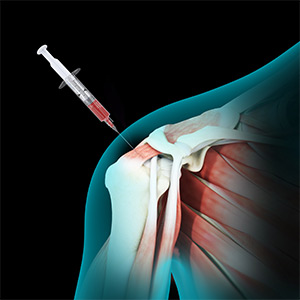 Picture of Bone Marrow Aspirate Concentrate (BMAC) Treatment