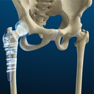 Hip Fracture Surgery