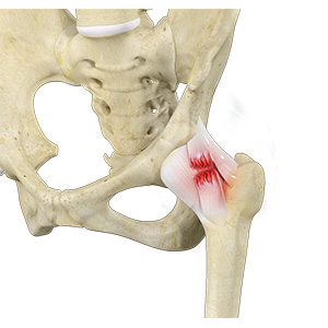Hip Ligament Injuries