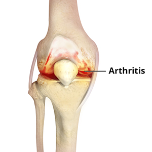 Picture of Knee Arthritis 