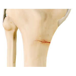 Knee Stress Fractures