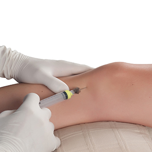 Picture of Microfragmented Adipose Tissue (MFAT)