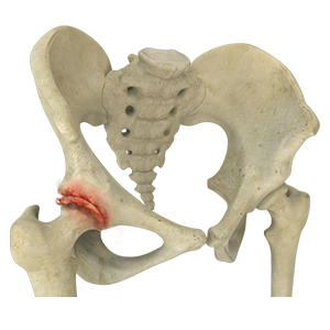 Picture of Osteoarthritis of the Hip 