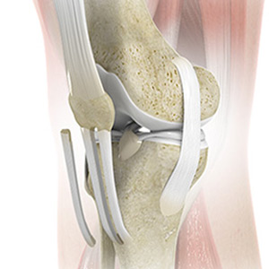 Patellar Tendon Repair
