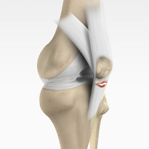 Patellar Tendon Rupture