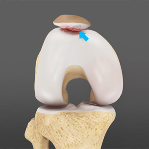 Patellofemoral Arthritis