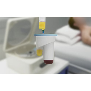 Picture of Platelet-Rich Plasma (PRP) Injection