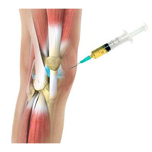 Picture of Platelet-Rich Plasma (PRP) Injection