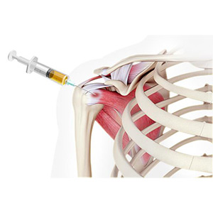 Picture of Platelet-Rich Plasma (PRP) Injection