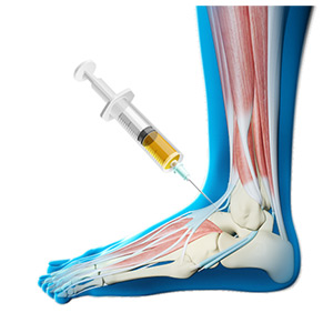 Picture of Platelet Rich Plasma (PRP) Injections for the Ankle