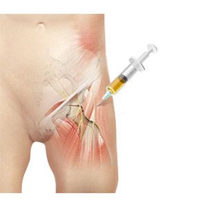 Picture of Platelet Rich Plasma (PRP) Injections for the Hip