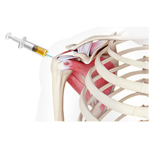 Platelet Rich Plasma (PRP) Injections for the Shoulder