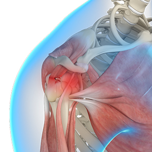Picture of Rotator Cuff Tear 