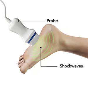Picture of Shockwave Therapy for Plantar Fasciitis