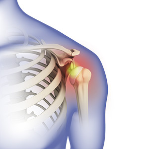 Shoulder Dislocation