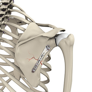 Shoulder Fracture Care