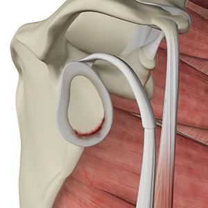Picture of Shoulder Labral Tear 