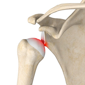 Shoulder Stabilization